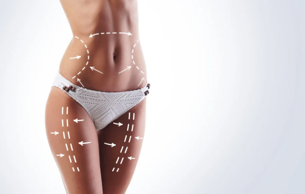 Smartlipo Triplex Treatment in Ventura, CA | IWH MedSpa