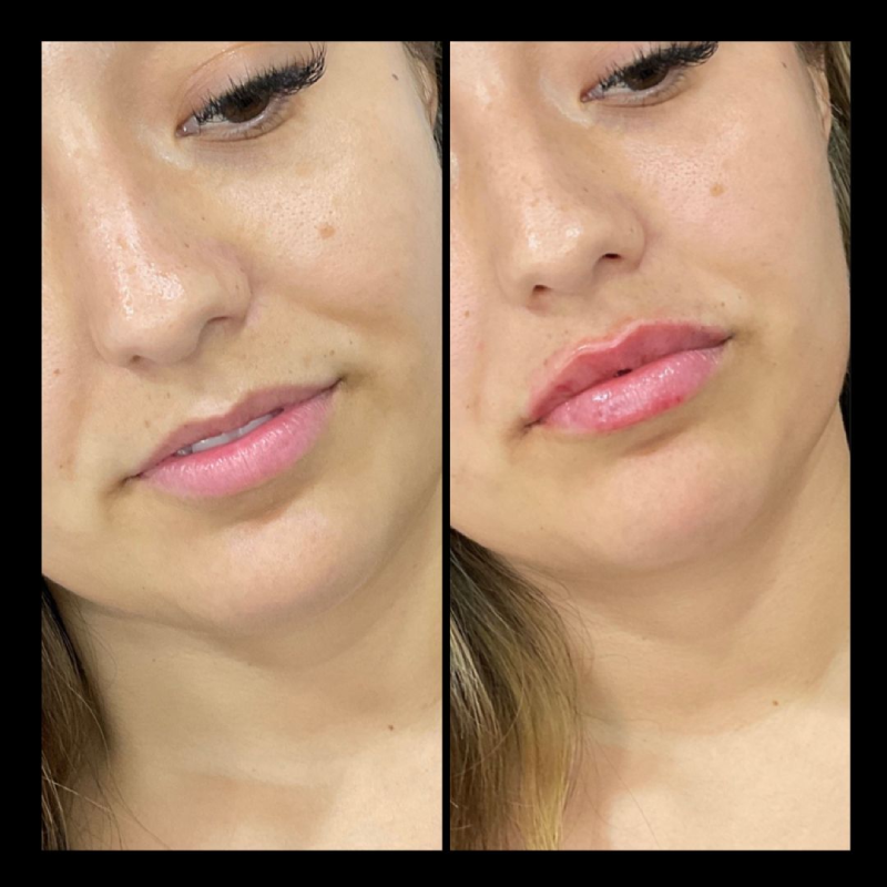 Before & After Filler Gallery | IWH MedSpa in Ventura, CA