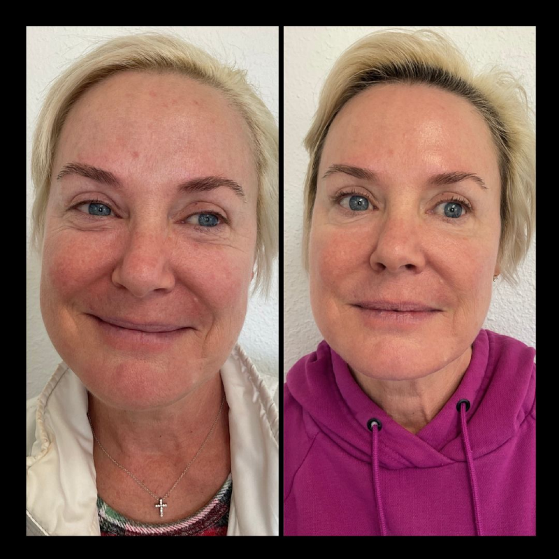 Before & After Lutronic Gallery | IWH MedSpa in Ventura, CA