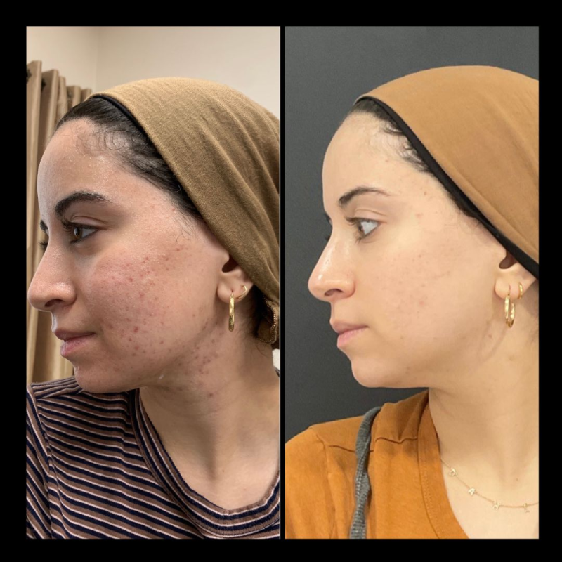 Before & After Skinpen Gallery | IWH MedSpa in Ventura, CA