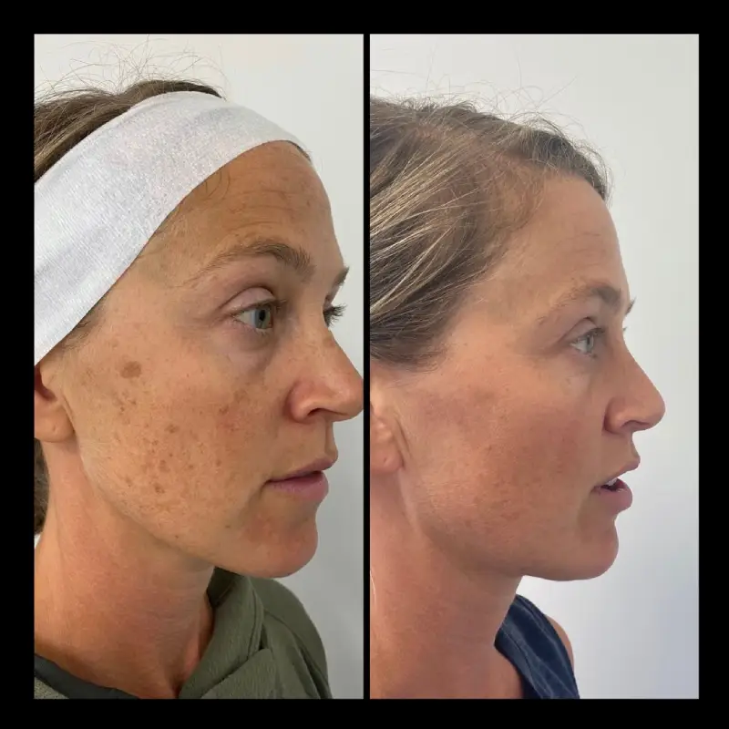 Gallery ba picosure in Ventura, CA | IWH Medspa