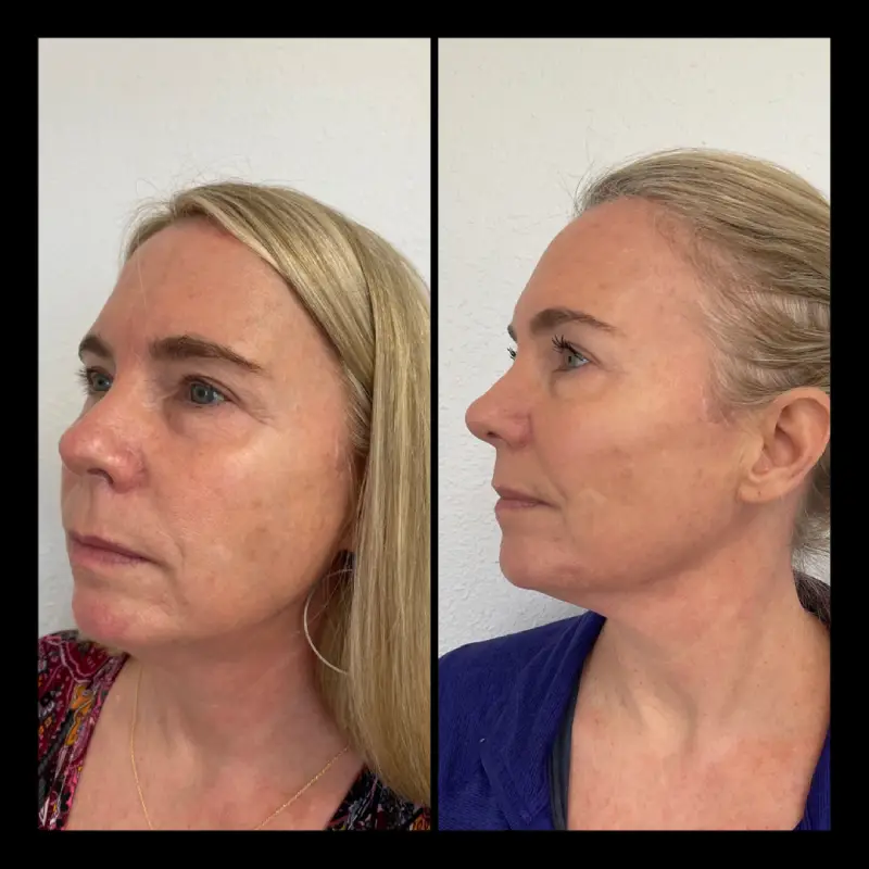 Skinpen in Ventura CA | IWH Medspa