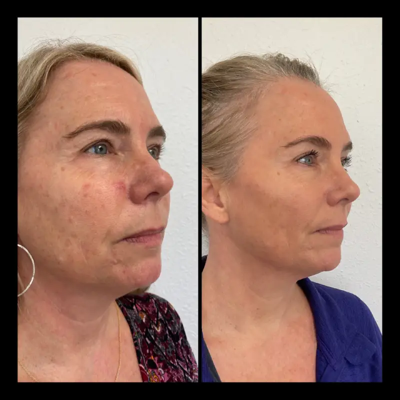 Skinpen in Ventura CA | IWH Medspa