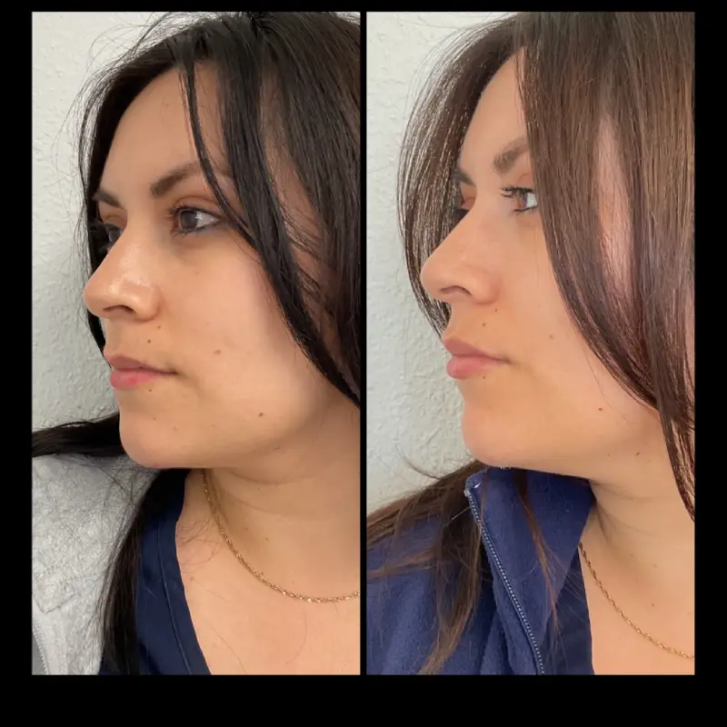 Lip Fillers in Ventura CA | IWH Medspa