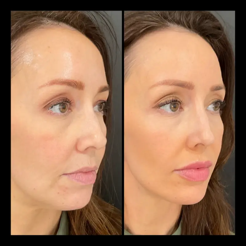 Lip Fillers in Ventura CA | IWH Medspa