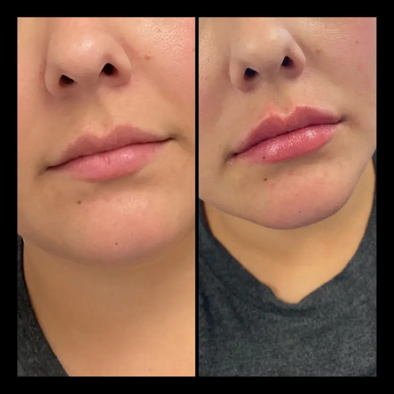 Lip Fillers in Ventura CA | IWH Medspa