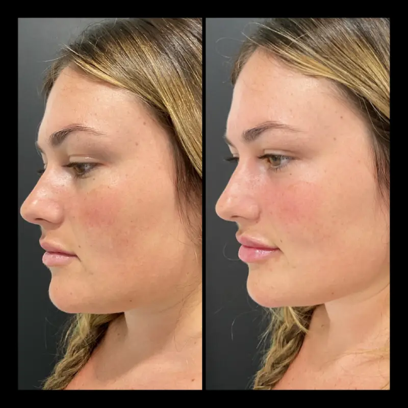 Lip Fillers in Ventura CA | IWH Medspa