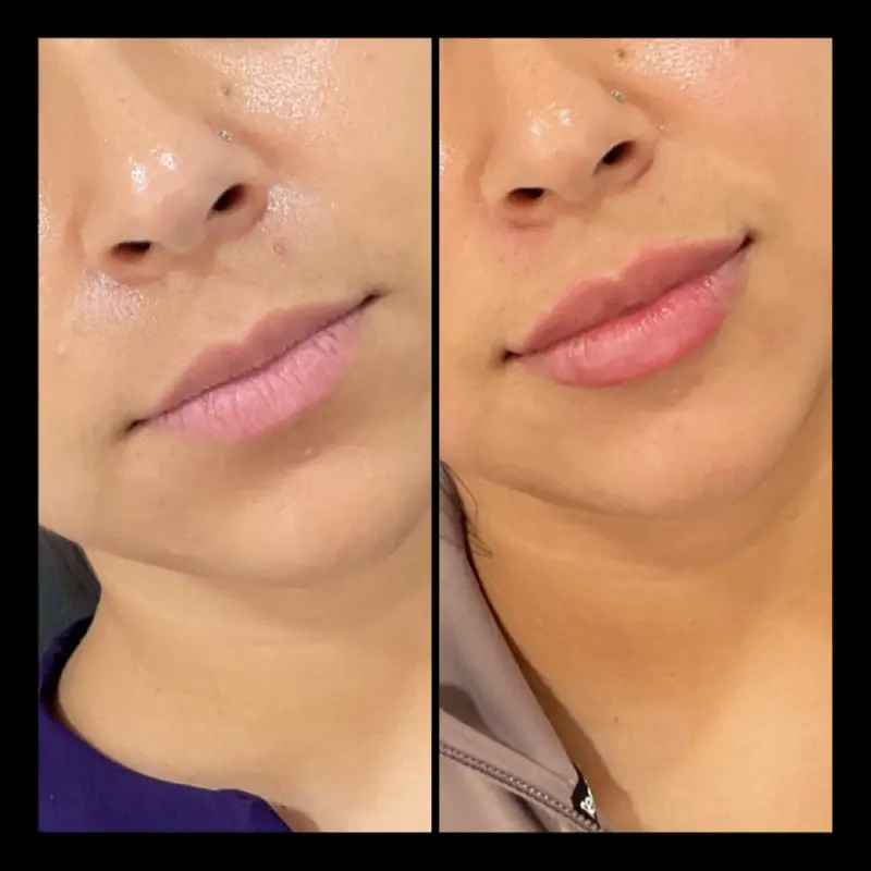 Lip Fillers in Ventura CA | IWH Medspa