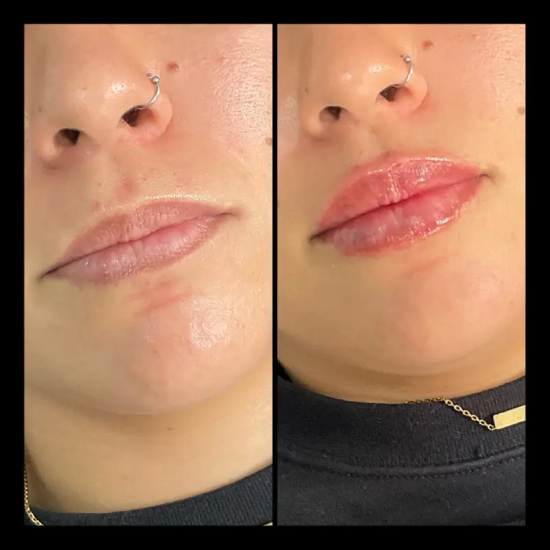 Lip Fillers in Ventura CA | IWH Medspa