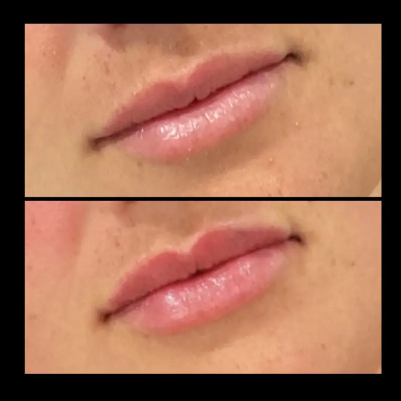 Lip Fillers in Ventura CA | IWH Medspa