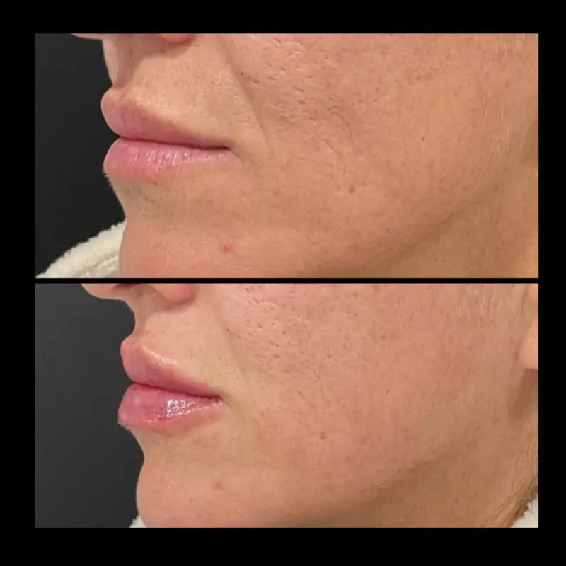 Lip Fillers in Ventura CA | IWH Medspa