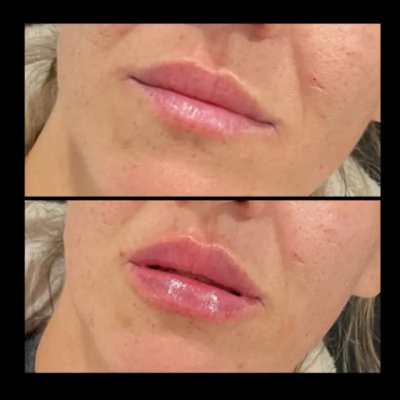 Lip Fillers in Ventura CA | IWH Medspa