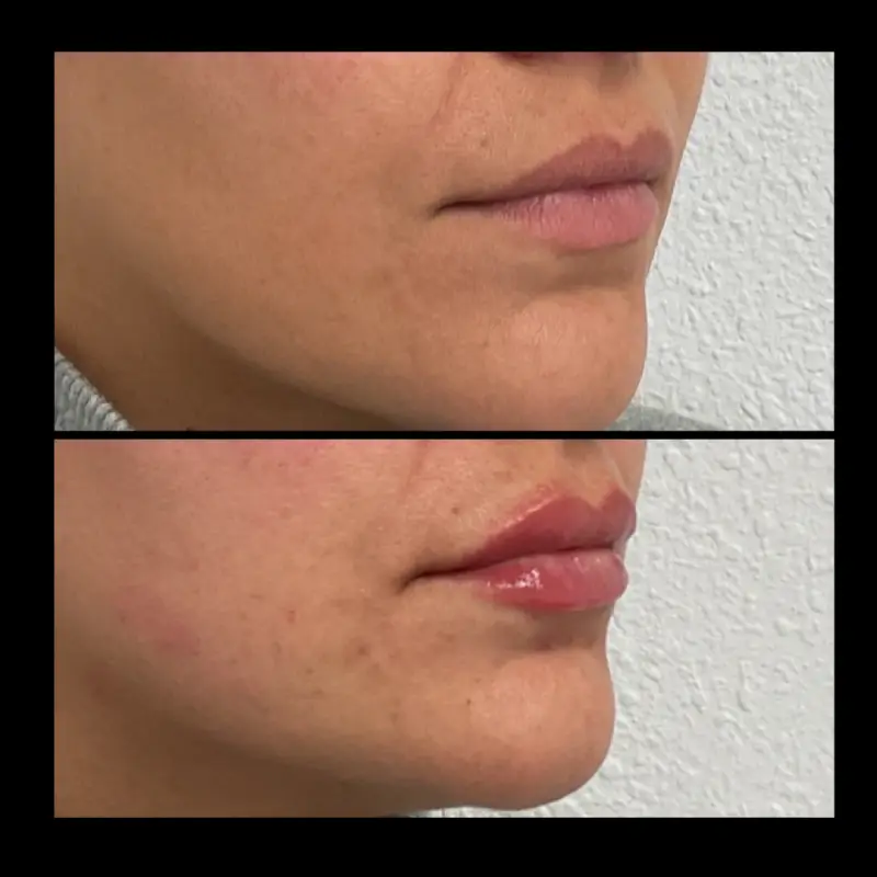 Lip Fillers in Ventura CA | IWH Medspa