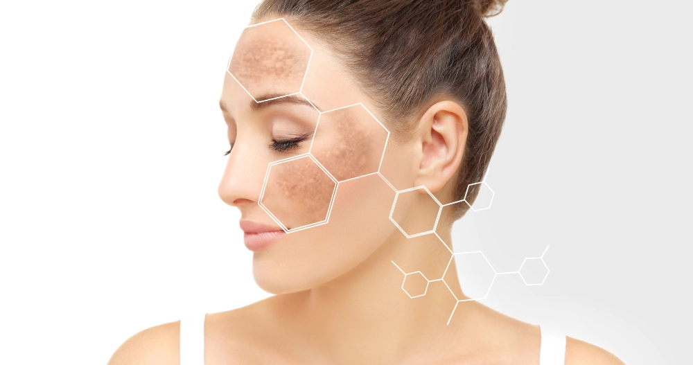 Melasma in Ventura, CA | IWH MedSpa