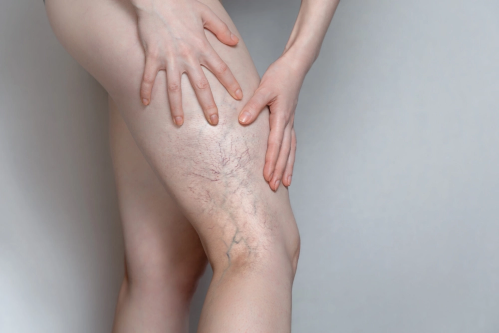 Spider and Varicose Veins in Ventura, CA | IWH Medspa