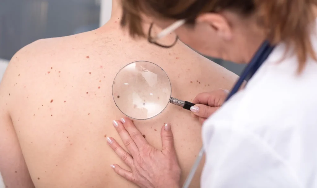 Cherry Angiomas in Ventura, CA | IWH Medspa