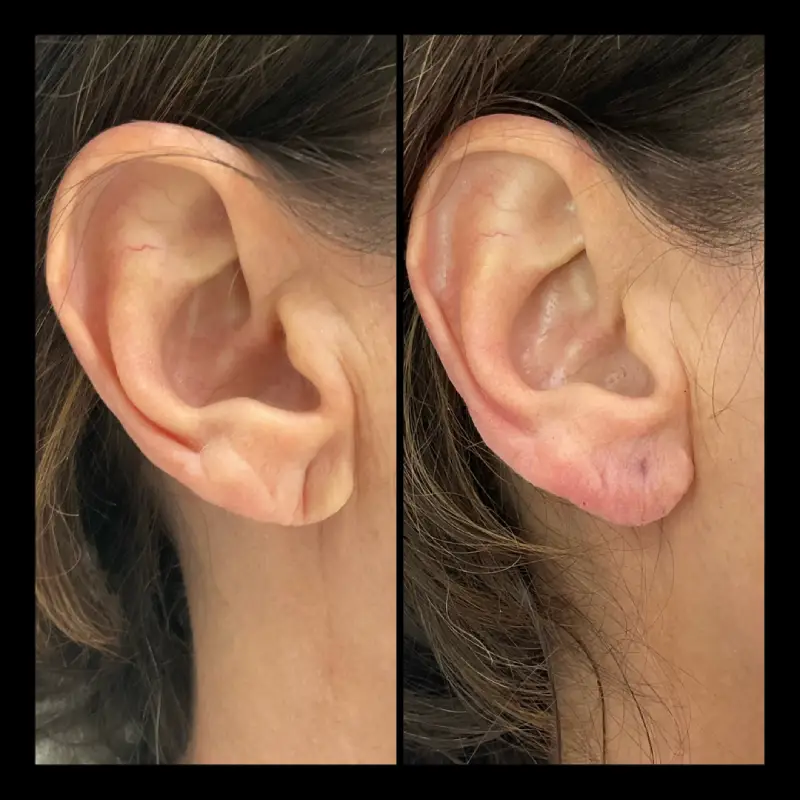 IWH-Medspa-gallery-Earlobe-ba-a-in-Ventura-CA