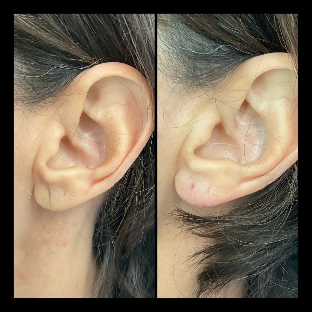 IWH-Medspa-gallery-Earlobe-ba-b-in-Ventura-CA