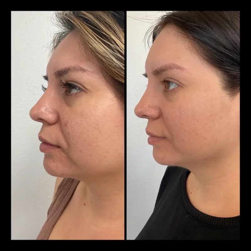 Skinpen Before and After in Ventura, CA | IWH Med Spa