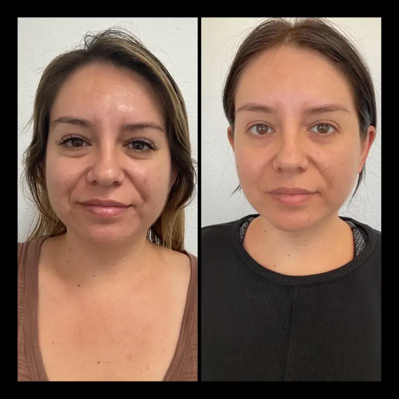 Skinpen Before and After in Ventura, CA | IWH Med Spa