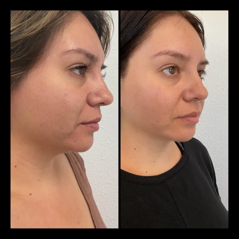 Skinpen Before and After in Ventura, CA | IWH Med Spa