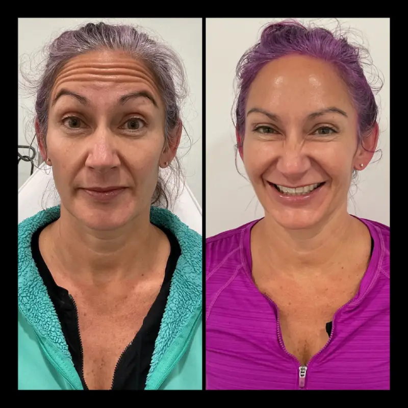 Botox and Dysport in Ventura, CA | IWH Med Spa