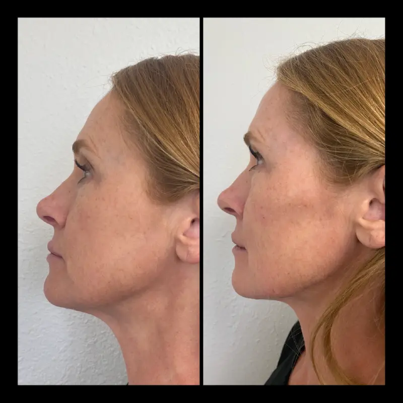 Cheek Filler Before and After in Ventura, CA | IWH Med Spa