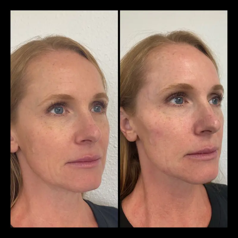 IWH-Medspa-gallery-cheek-filler-ba-b-in-Ventura-CA