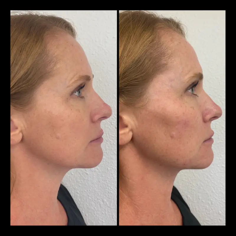 IWH-Medspa-gallery-cheek-filler-ba-c-in-Ventura-CA