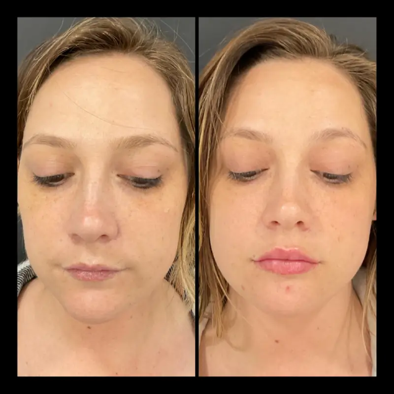 Ipl Lip Filler before and after in Ventura, CA | IWH Med Spa