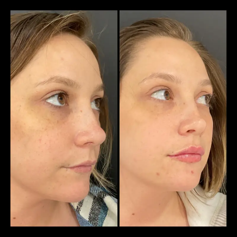 IPL Lip Filler Before and After in Ventura, CA | IWH Med Spa