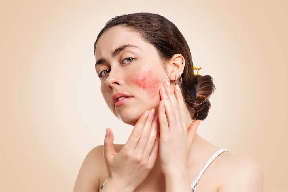 Rosacea