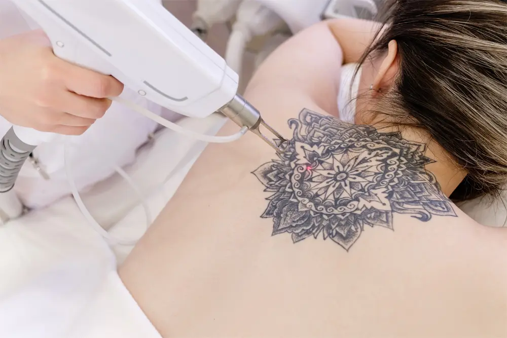 Unwanted Tattoos