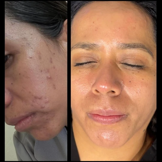Aesthetician Face Treatment by IWH Medspa in Ventura, CA