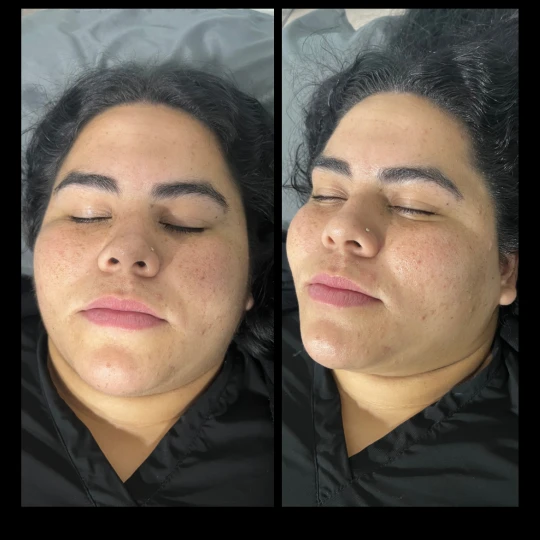 Aesthetician Face Treatment by IWH Medspa in Ventura, CA