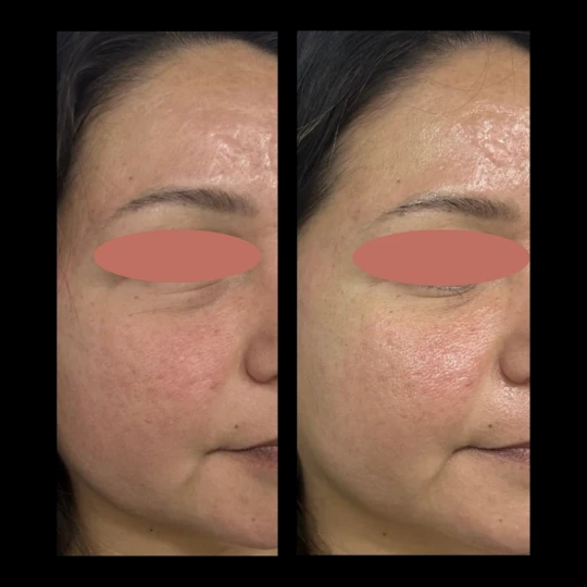 Aesthetician Face Treatment by IWH Medspa in Ventura, CA