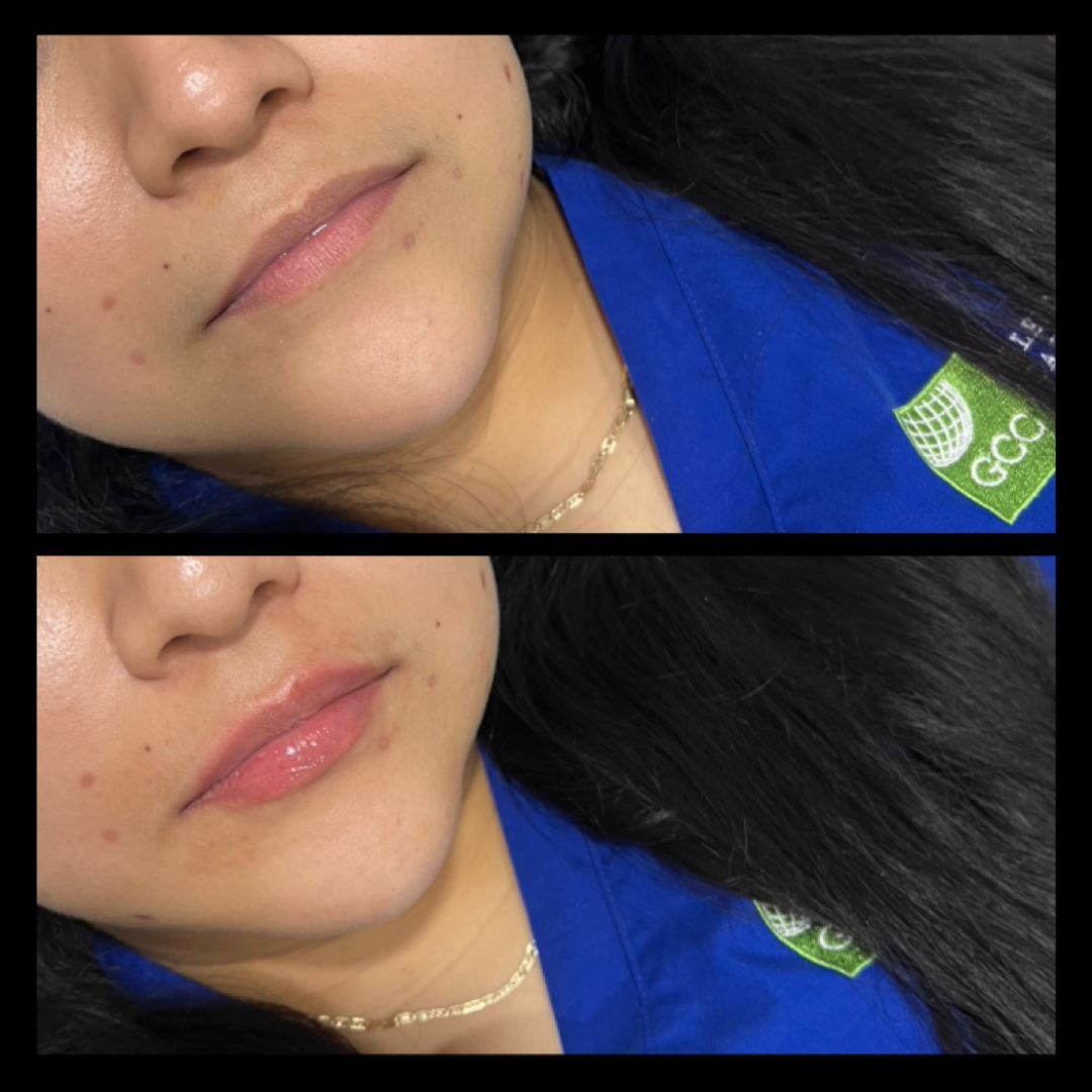 Lip filler (2)